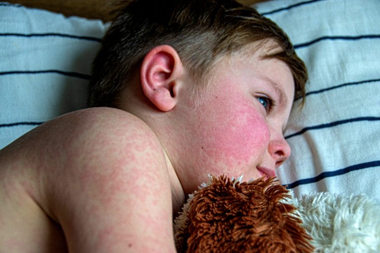 A young boy with flushed cheeks lies on a striped pillow, holding a stuffed animal close, looking contemplative.